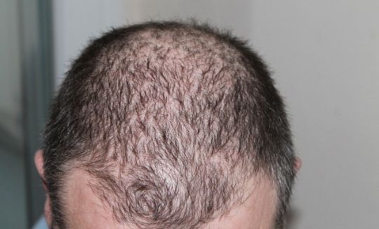 How to Stop hair loss Due to Weight Loss